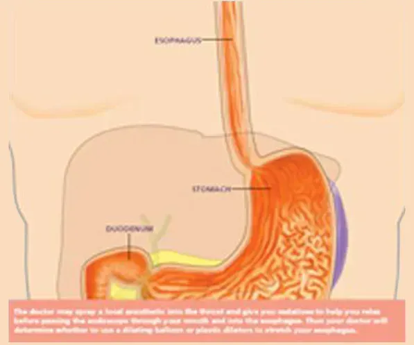 Esophageal Dialation