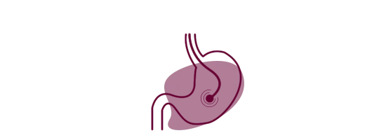 Endoscopic Retrograde Cholangio Pancreatography-ERCP