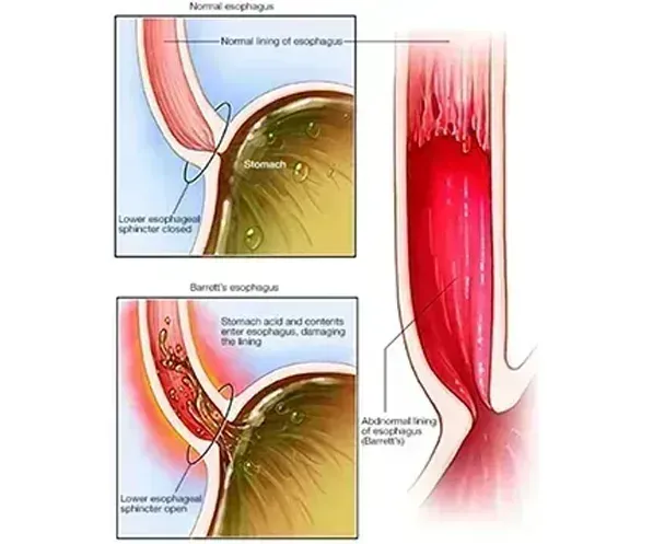 BARRETT’S ESOPHAGUS