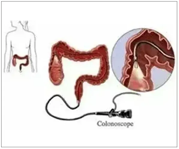 COLON CANCER SCREENING AND SURVEILLANCE