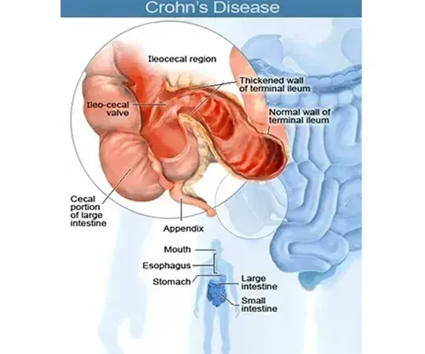 CROHN'S DISEASE