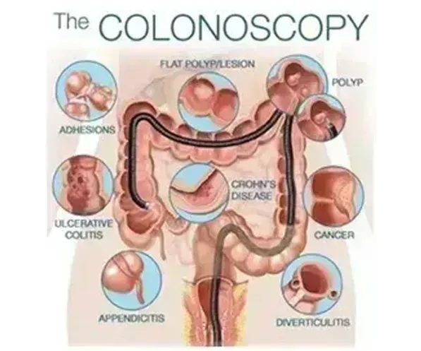 colonoscopy