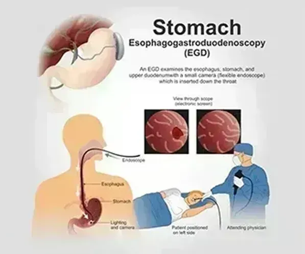 Endoscopy