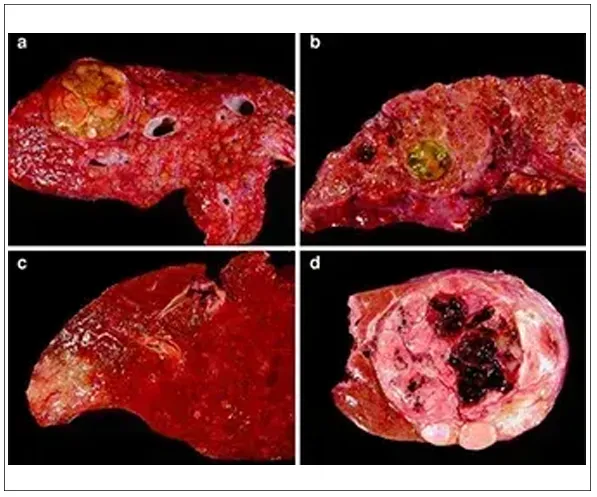 LIVER TUMORS