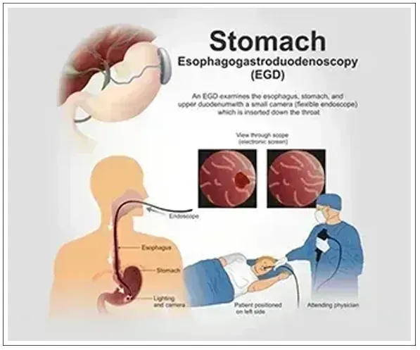 Endoscopy