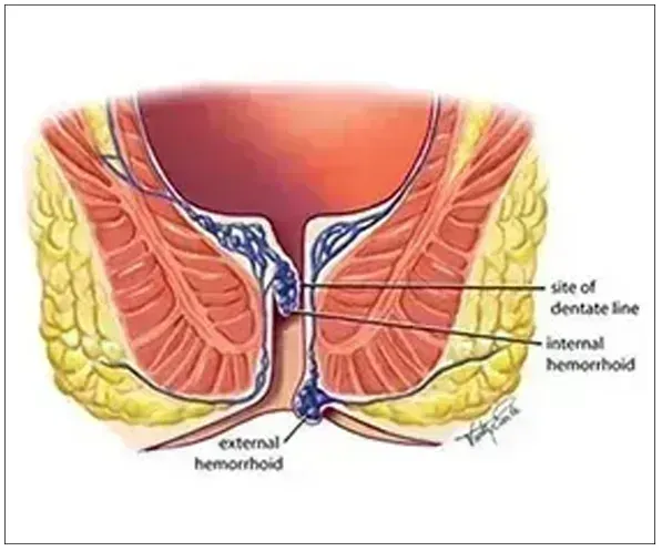 Hemorrhoids