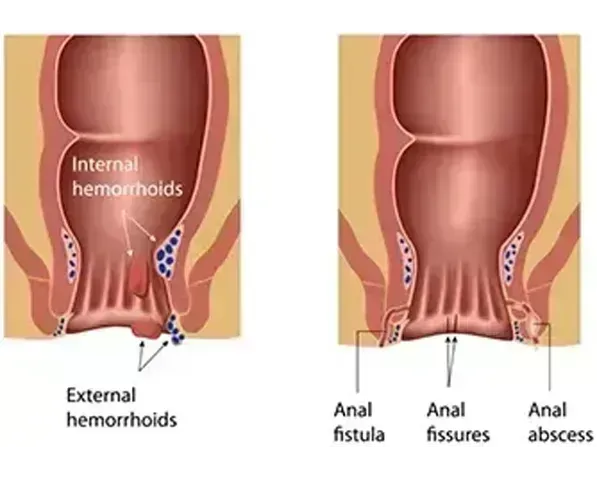 Hemorrhoids and Fissures