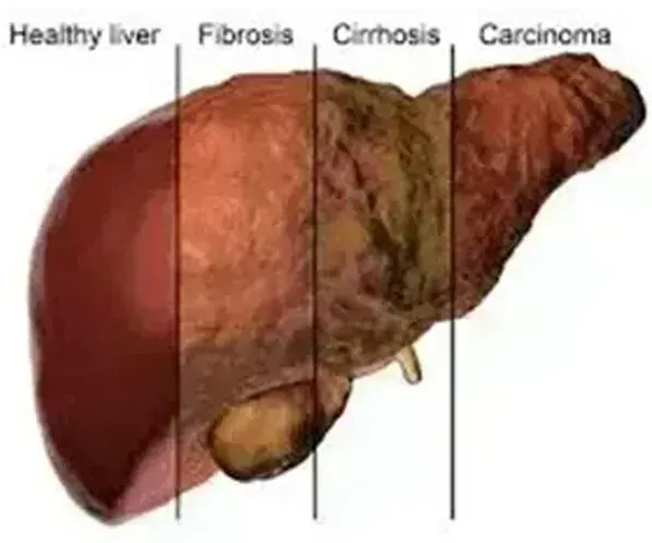 Liver Cirrhosis