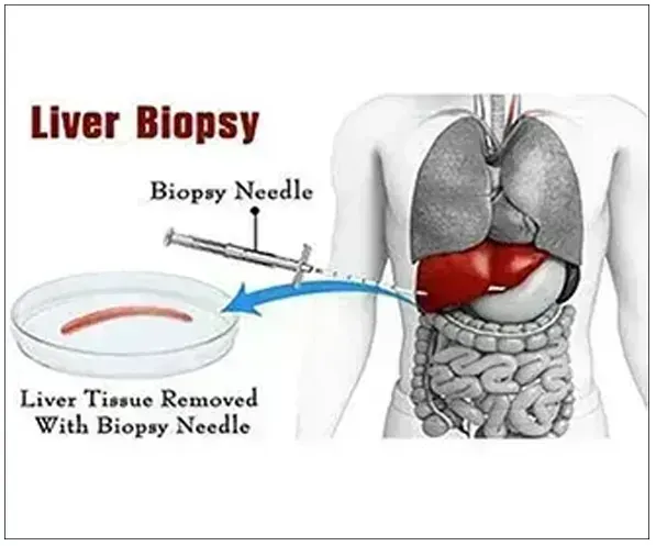 Liver Biopsy (Ultrasound guided)