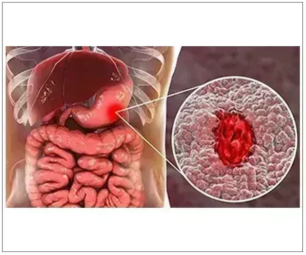 Stomach / Peptic ulcers