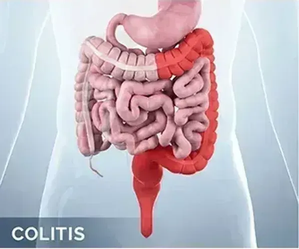 Ulcerative Colitis