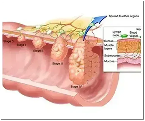 COLORECTAL CANCER