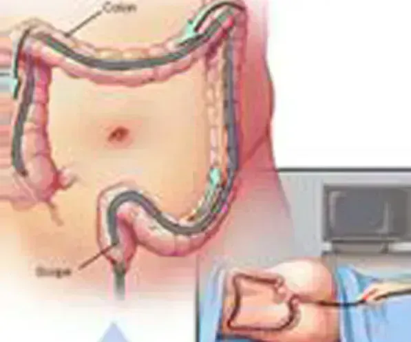 Colonoscopy Procedure