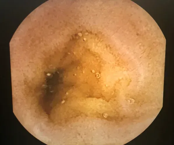 Capsule Endoscopy