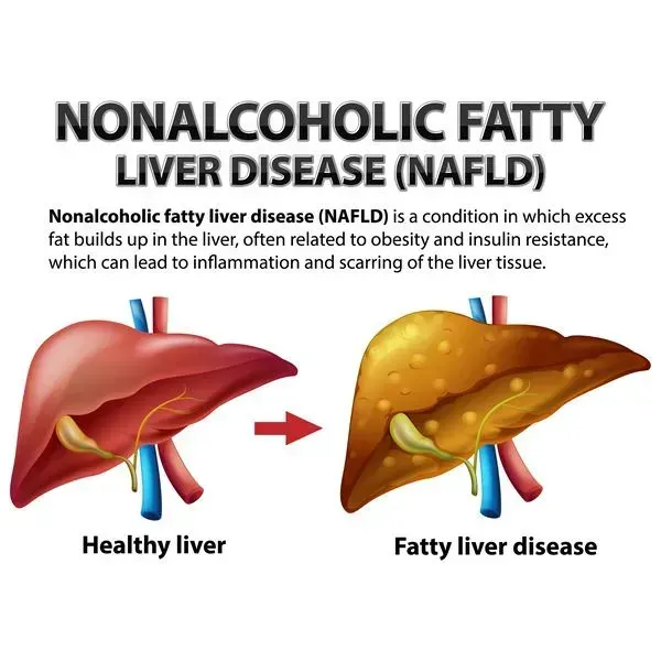 non alcoholic fatty liver disease