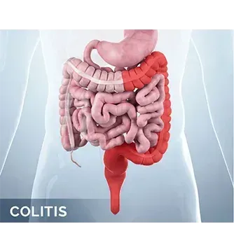 Ulcerative Colitis