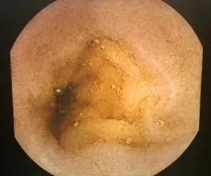 Capsule Endoscopy