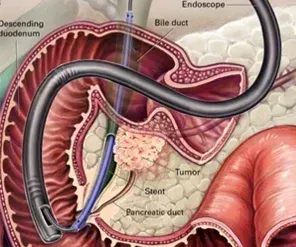 Endoscopic Stent Placement