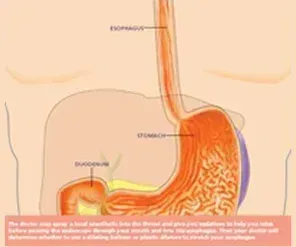 Esophageal Dialation