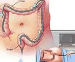 Colonoscopy Procedure