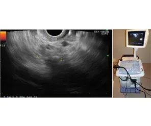 Endoscopic Ultrasound