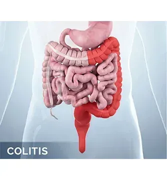 Ulcerative Colitis